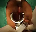 Identify Internal Opening